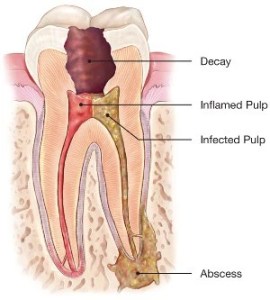 Root Canal Therapy illustration