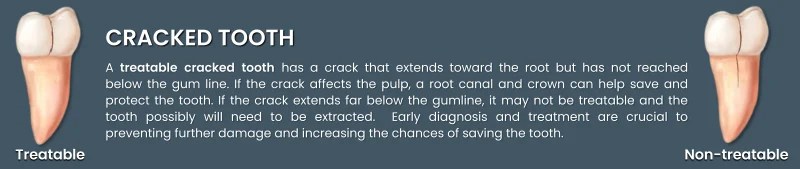 Treatment of Cracked Teeth illustration