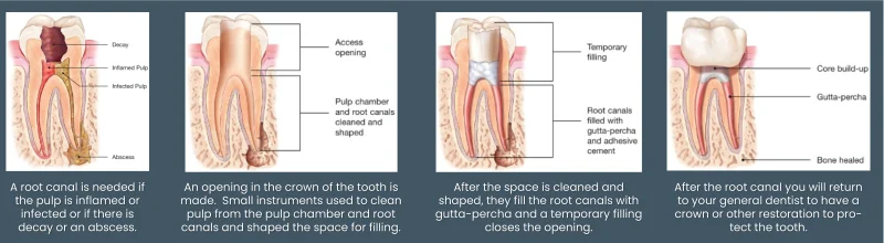 Root Canal Therapy illustration