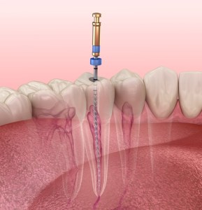 Root Canal Therapy illustration