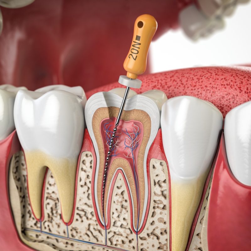 Endodontic treatment illustration