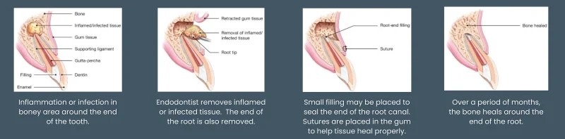 Apicoectomy illustration
